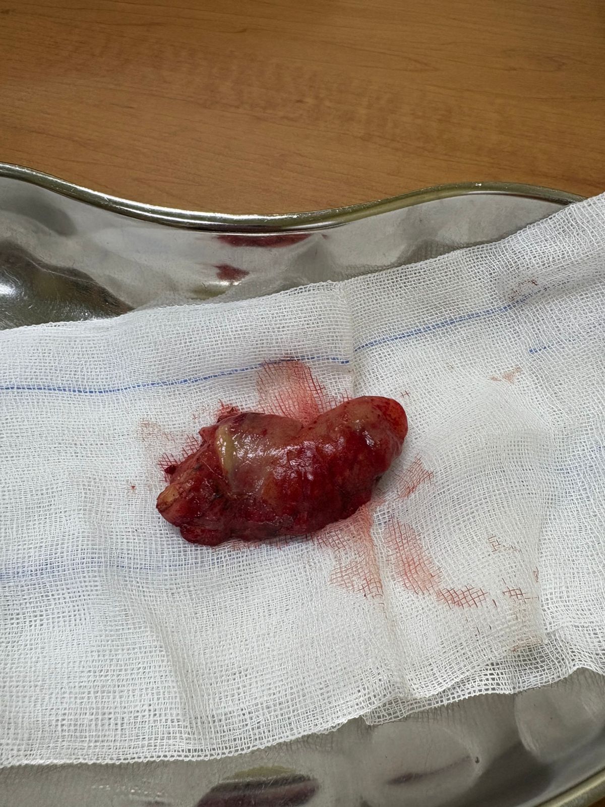 Momento of surgery